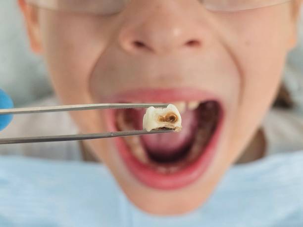 Best Broken or Cracked Tooth Emergency Dentist in Slatington, PA